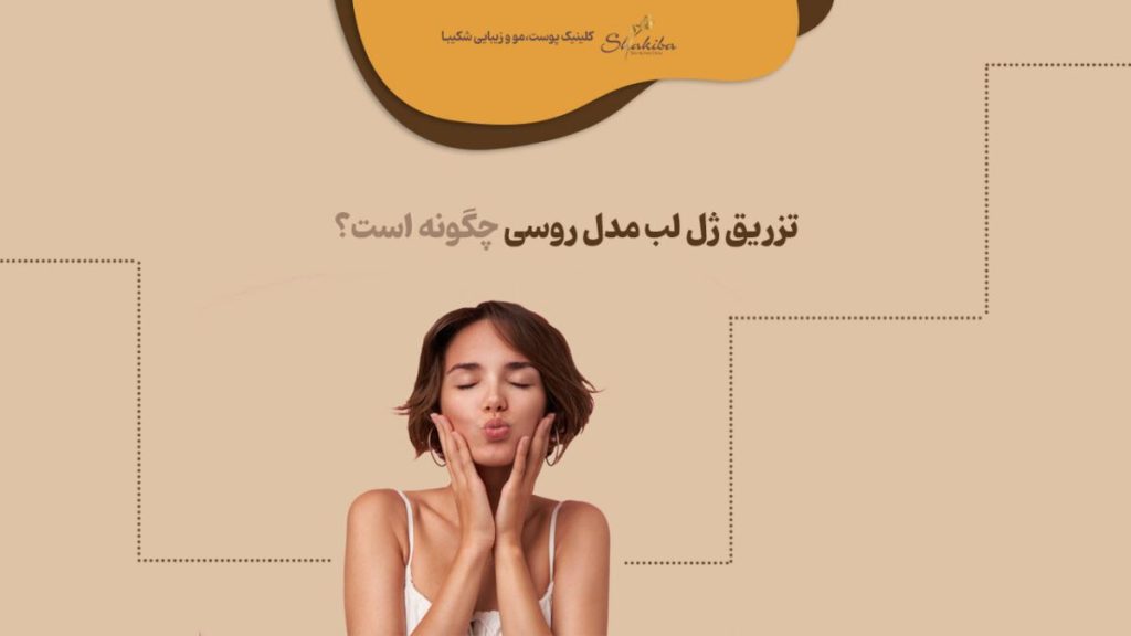 تزریق ژل لب مدل روسی