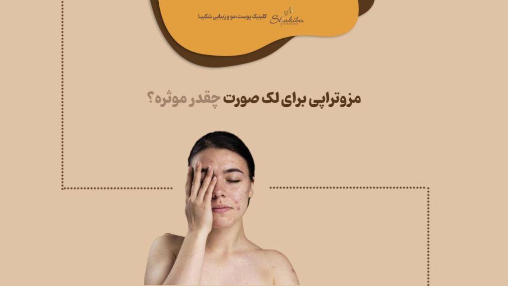 مزوتراپی برای لک صورت