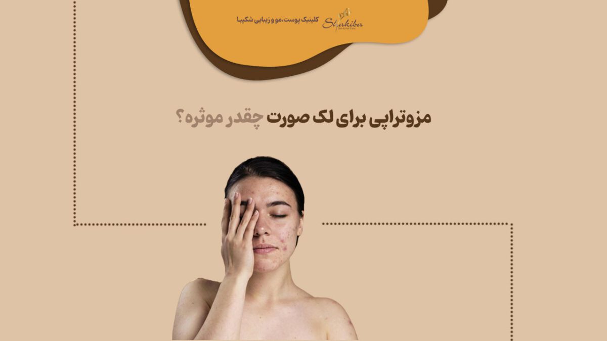 مزوتراپی برای لک صورت