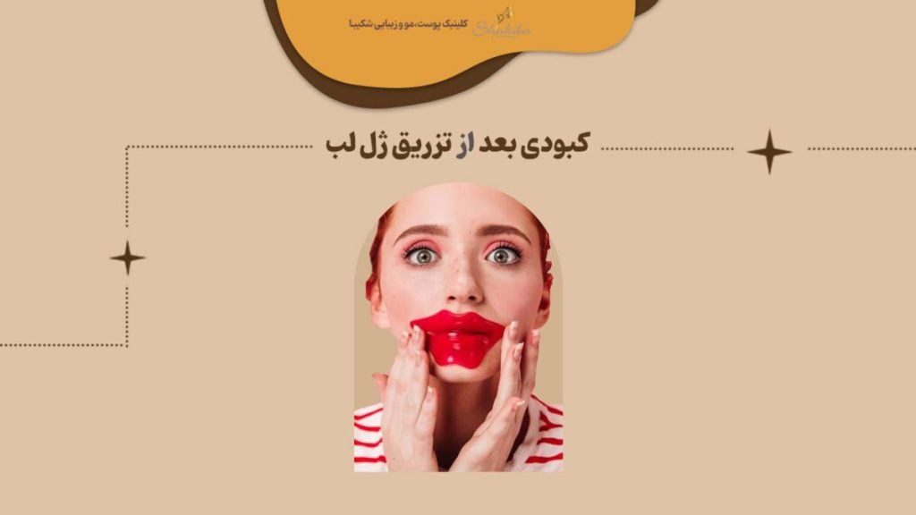 کبودی بعد از تزریق ژل لب
