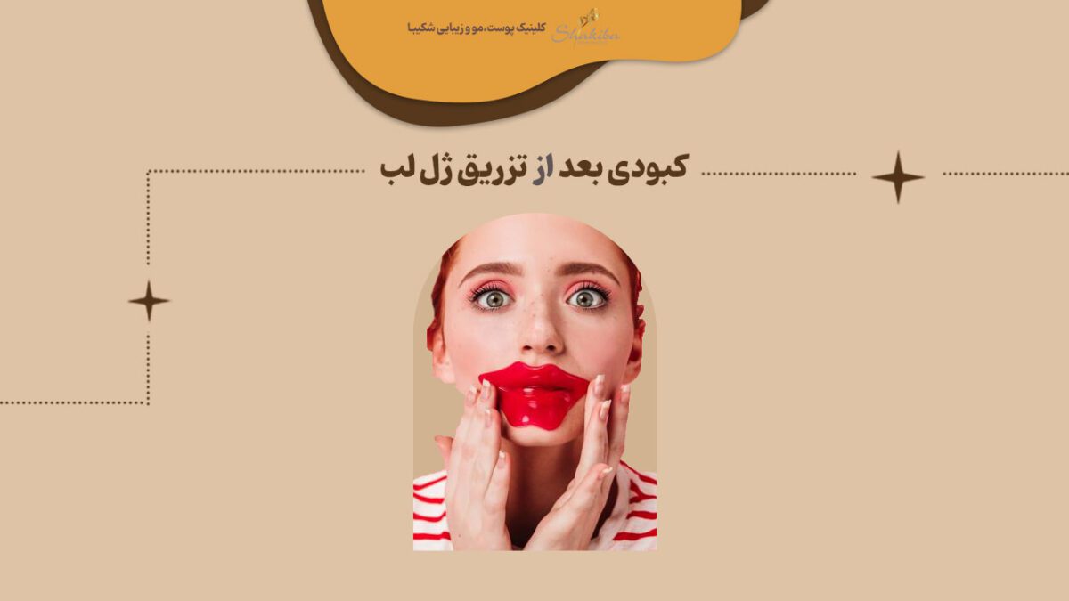 کبودی بعد از تزریق ژل لب