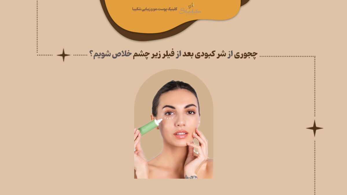 کبودی بعد از فیلر زیر چشم