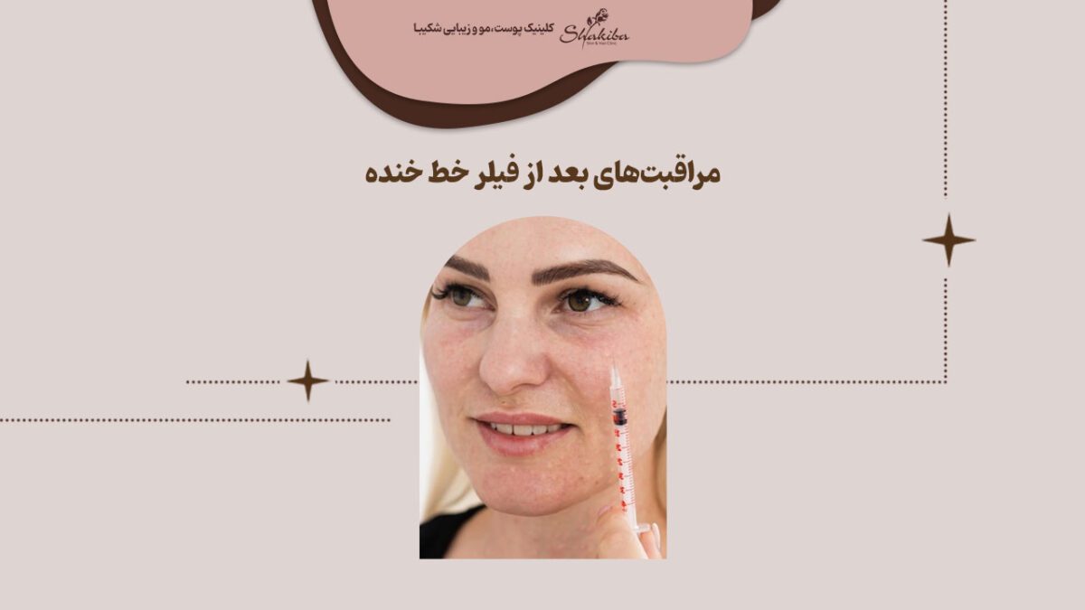 مراقبتهای بعد از فیلر خط خنده