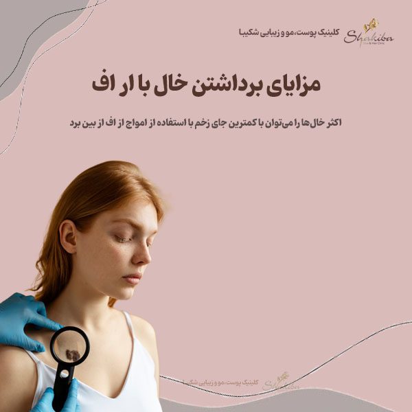 مزایای برداشتن خال با ار اف