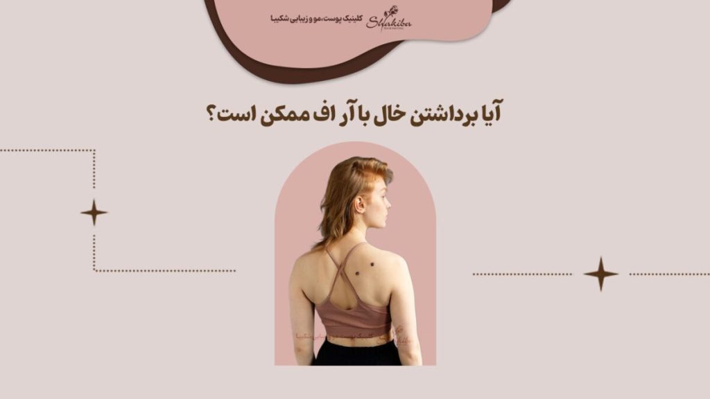 روش برداشتن خال با آر اف
