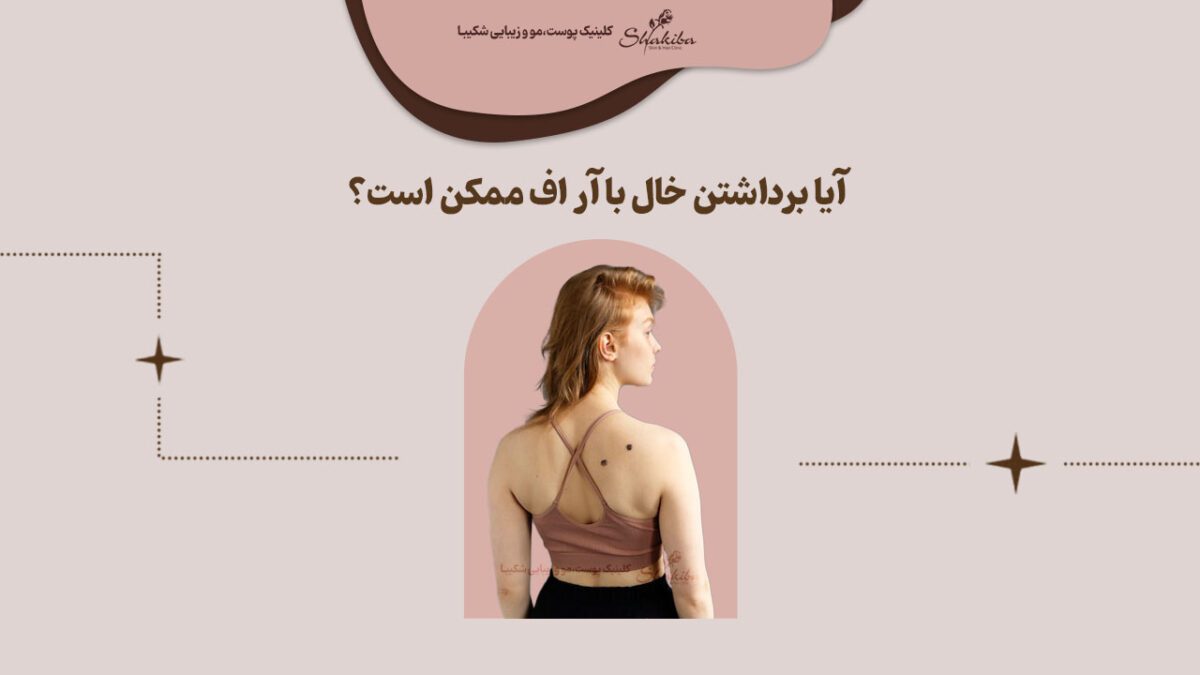 روش برداشتن خال با آر اف