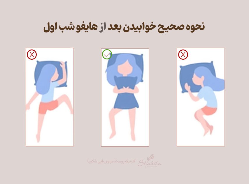 نحوه خوابیدن بعد از هایفو