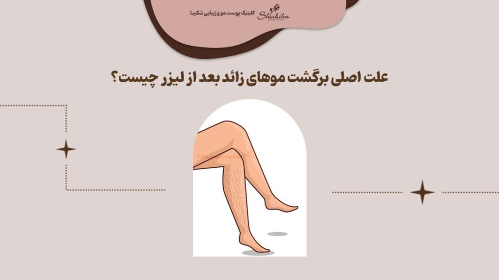 علت اصلی برگشت موهای زائد بعد از لیزر