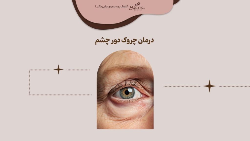 علت و درمان چروک دور چشم