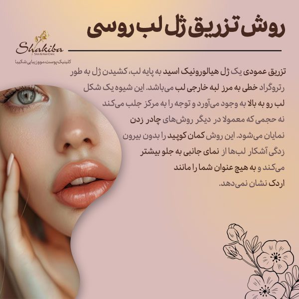 روش تزریق ژل لب روسی